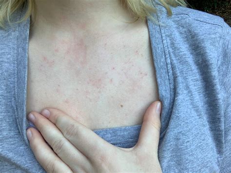 Der wickel sollte mindestens eine stunde am hals bleiben. Rot am Hals? (Gesundheit und Medizin, Gesundheit, Freizeit)
