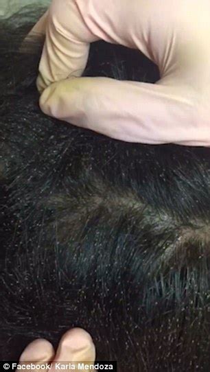 Is this the worst case of head lice EVER? Mother posts ...