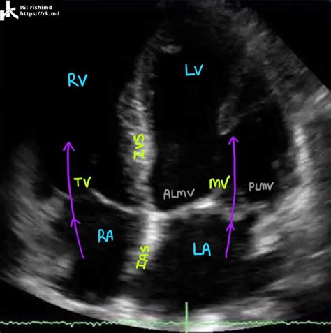 Cardiac Transthoracic Echocardiography Tte Summary And Labeled