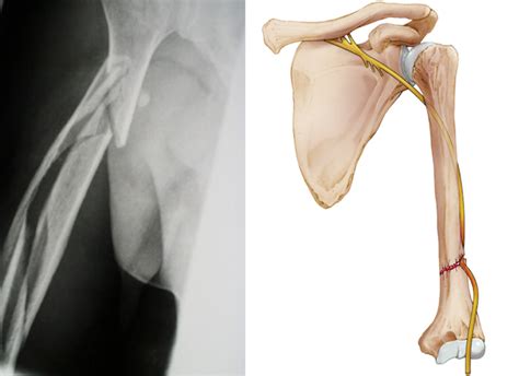 Humeral Shaft Fracture