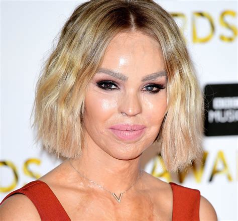 Katie Piper For Acid Attack Survivors The Aftermath Is A Life