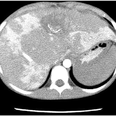 Axial Ct Scan Of The Abdomen Showing Multiple Hypodense Hepatic Lesions