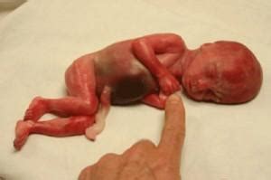 Polymelia is a congenital defect in which the affected baby is born with more limbs than usual. 10 babies born alive after botched abortions in 2015…in ...