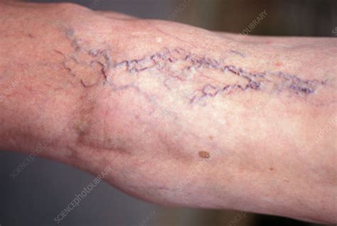 Varicose Veins Stock Image M2900166 Science Photo Library