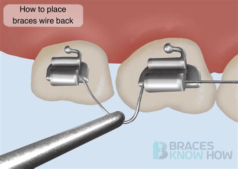 Braces Wire Came Out Of The Back Bracket Heres What To Do