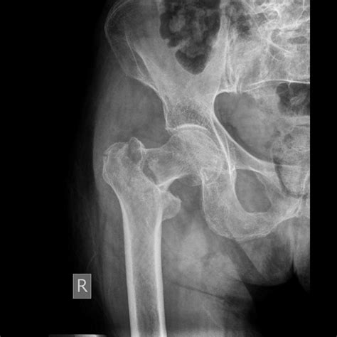 Femoral Neck Fractures Core Em