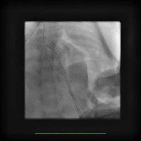 Pulmonary Valve Perforation And Stent Implantation In The Right