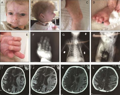 Novel Lmna Mutations Cause An Aggressive Atypical Neonatal Progeria