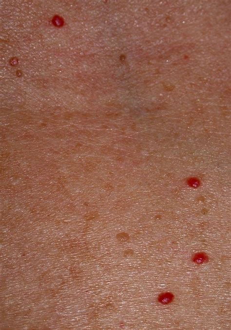 Cherry Angioma Tiny Pinpoint Red Dots On Skin Weekendxoler