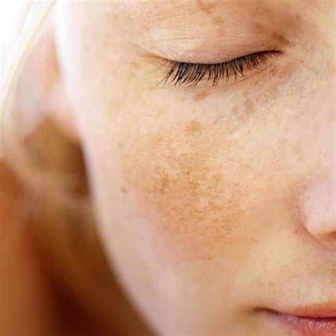 Manchas brancas na pele o que são Tipos e tratamentos
