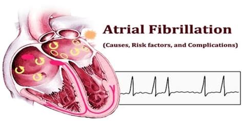 Atrial fibrillation (af) is the most common arrhythmia encountered by clinicians. Atrial Fibrillation (Causes, Risk factors, and ...