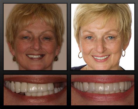 Dental Implant Before And After Photos