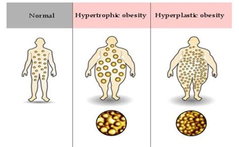 Fome Oculta Tipo De Obesidade Em Relação às Células Gordurosas