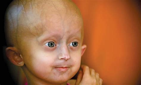 โรคชราในเด็ก Hutchinson Gilford Progeria Syndrome