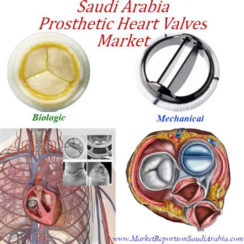 Saudi Arabia Prosthetic Heart Valves Market Feedsfloor