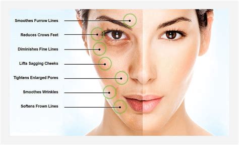 Skinpen Microneedling Treatments In Pittsburgh Pa Sistine Facial