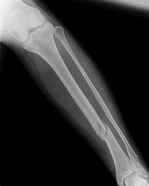 Nitial Radiograph Showing The Patients Midshaft Displaced Tibia And