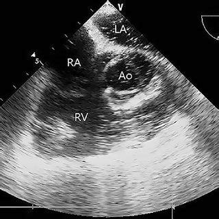 Midesophageal Right Ventricle Inflow Outflow View Of The Download