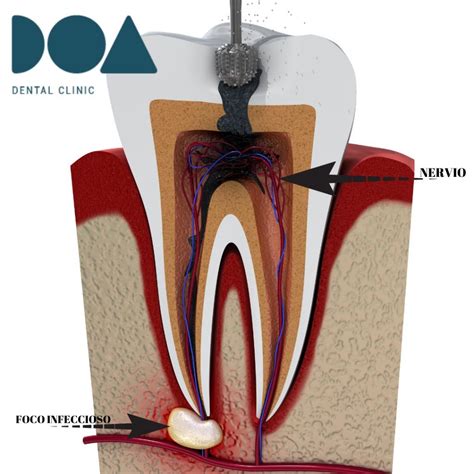 QUÉ ES UNA ENDODONCIA DOA Dental Clinic