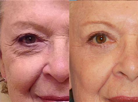 Eyelid Surgery Upper Lower Blepharoplasty Surgery Recovery