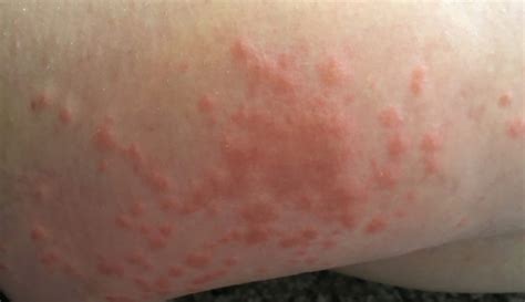 Skin Rashes Are The Only Symptom For 1 In 5 Covid Patients Docs Warn