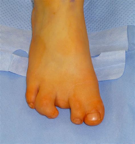 Toe Syndactyly Congenital Hand And Arm Differences Washington