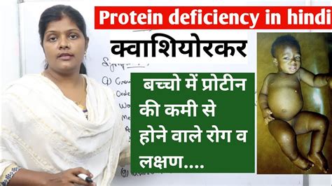 What Is Protein Deficiency Kwashiorkor In Hindi क्वाशियोरकर
