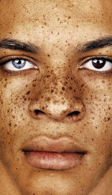 Why Do We Have Freckles On Our Face Frolicious Deine Afro Haare