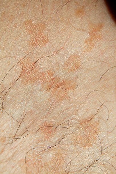 Cependant, certaines mycoses de la peau peuvent etre des candidoses, notamment au niveau des plis. Pityriasis Versicolor - Photos et Images Libres de Droits - iStock