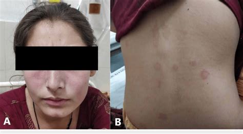 A Erythematous And Non Blanching Malar Rash On The Face With