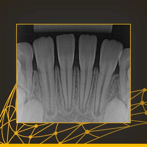 Radiografia Periapical Como é Feita