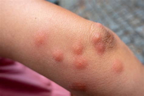 Difference Between Bed Bug Bites Vs Mosquito Bites EcoGuard