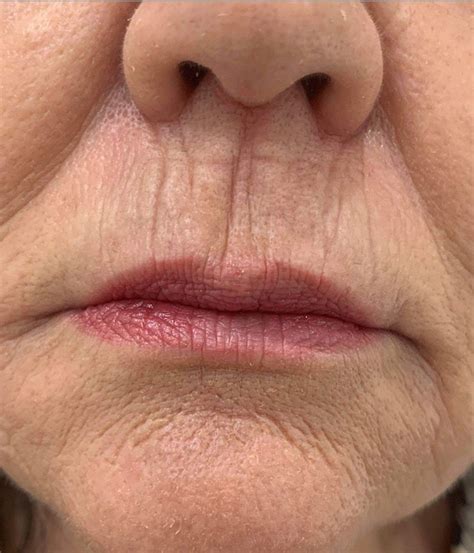Lip Lines Treatment Adelaide Advanced Cosmetic Medicine