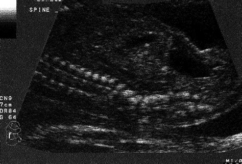Longitudinal Ultrasonographic Scan Of The Spine Of A Second Trimester