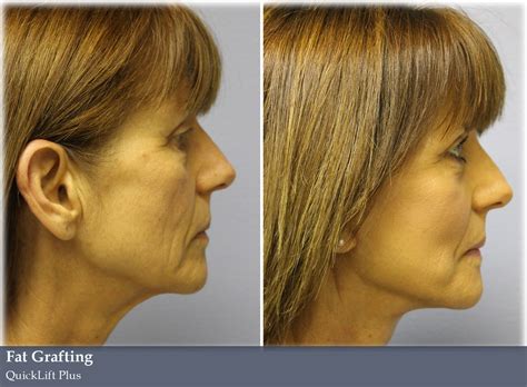 Fat Grafting Vargas Face And Skin Center