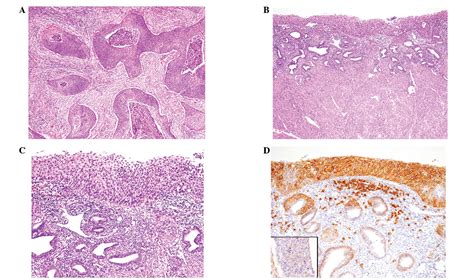 Superficial Spreading Squamous Cell Carcinoma Of The Uterine Cervix