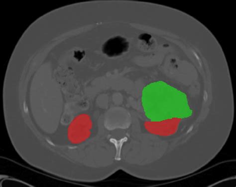 3d Kidneys And Kidney Tumor Semantic Segmentation Using Boundary Aware