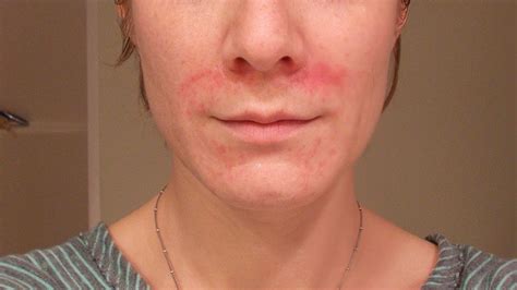 Facial Eczema Symptoms Treatments And Causes