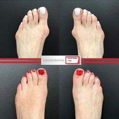 This Picture Illustrates Various Degrees Of Bunion Deformity From Mild To Severe Bunions Also