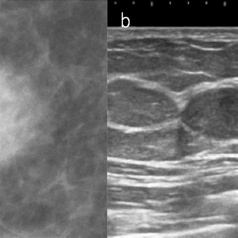 A Case Of Architectural Distortion On Mammography A Mammography