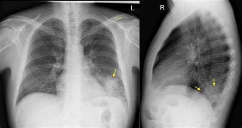 Left Lower Lobe Pneumonia Lateral Cxr Radiology At St Vincents