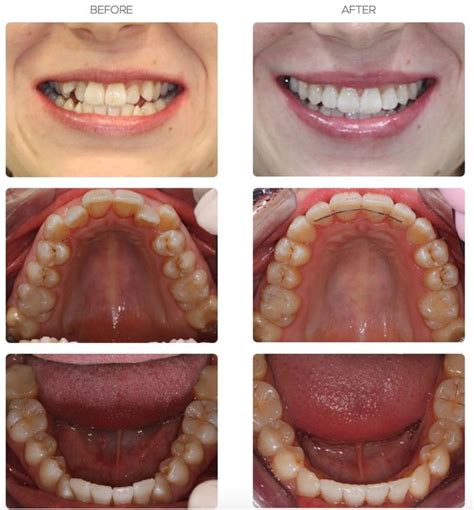 Invisalign Before And After Crowding