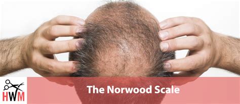 In the early stages, hair loss can be treated with medications. What Is The Norwood Scale & How Bald Are You According To ...
