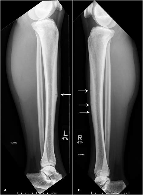 lateral x ray of left a and right b tibia and fibula download scientific diagram