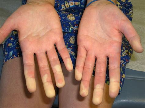 Mixed Connective Tissue Disease Causes Symptoms Treatment