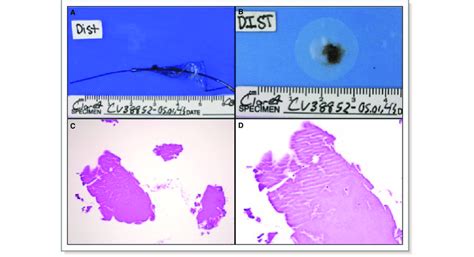 Macroscopic And Microscopic View Acute Thrombus Gross Images Of The