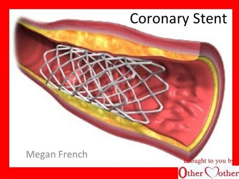 What Does A Stent Look Like I Have A Stents In My Aorta Due To The