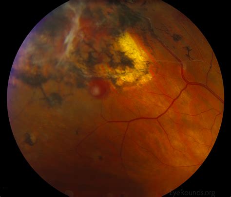 Retinal Capillary Hemangioma