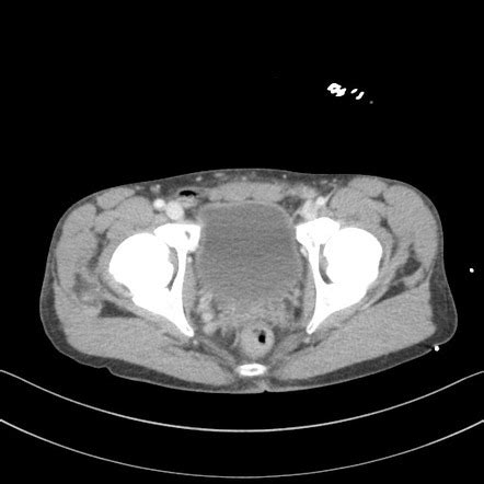 Amyand Hernia Radiology Reference Article Radiopaedia Org
