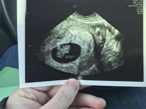 More notes on your hcg level at 8 week pregnancy in a normal pregnancy, hcg levels are a marker of how things are progressing. Just had my 8 week scan.. new photo same scan - Page 1 ...